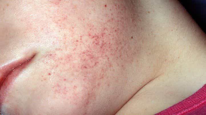 small red pinpoint rash